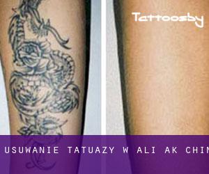 Usuwanie tatuaży w Ali Ak Chin