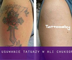 Usuwanie tatuaży w Ali Chukson