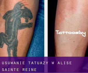 Usuwanie tatuaży w Alise-Sainte-Reine