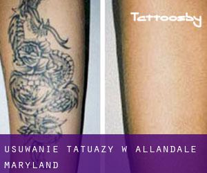 Usuwanie tatuaży w Allandale (Maryland)