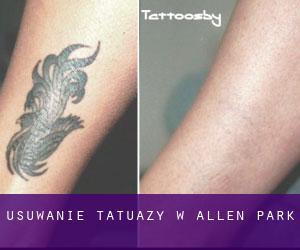 Usuwanie tatuaży w Allen Park