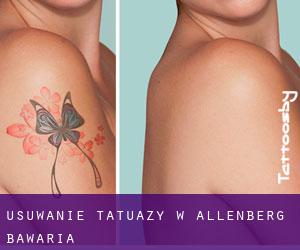 Usuwanie tatuaży w Allenberg (Bawaria)