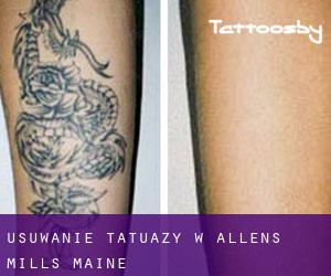 Usuwanie tatuaży w Allens Mills (Maine)