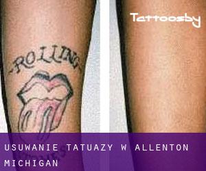 Usuwanie tatuaży w Allenton (Michigan)