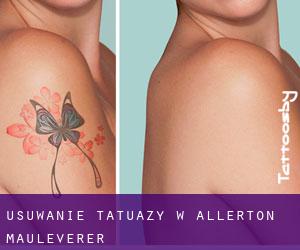 Usuwanie tatuaży w Allerton Mauleverer