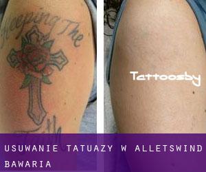 Usuwanie tatuaży w Alletswind (Bawaria)