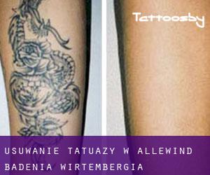 Usuwanie tatuaży w Allewind (Badenia-Wirtembergia)