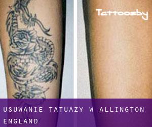 Usuwanie tatuaży w Allington (England)