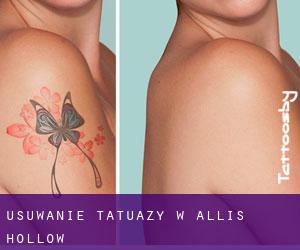 Usuwanie tatuaży w Allis Hollow