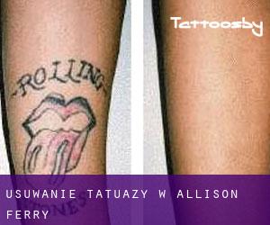 Usuwanie tatuaży w Allison Ferry