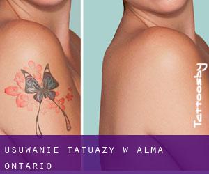 Usuwanie tatuaży w Alma (Ontario)