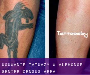 Usuwanie tatuaży w Alphonse-Génier (census area)