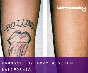 Usuwanie tatuaży w Alpine (Kalifornia)