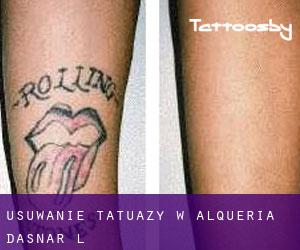 Usuwanie tatuaży w Alqueria d'Asnar (l')
