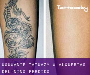 Usuwanie tatuaży w Alquerías del Niño Perdido