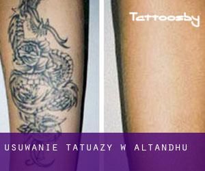 Usuwanie tatuaży w Altandhu