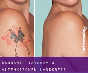 Usuwanie tatuaży w Altenkirchen Landkreis
