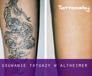 Usuwanie tatuaży w Altheimer