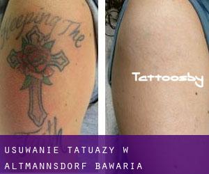 Usuwanie tatuaży w Altmannsdorf (Bawaria)