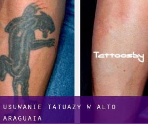 Usuwanie tatuaży w Alto Araguaia