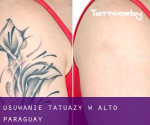 Usuwanie tatuaży w Alto Paraguay