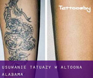 Usuwanie tatuaży w Altoona (Alabama)