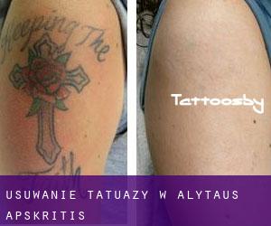 Usuwanie tatuaży w Alytaus Apskritis