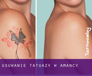 Usuwanie tatuaży w Amancy