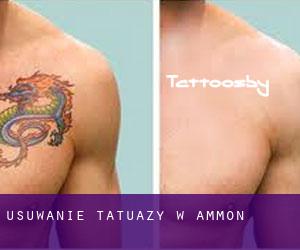 Usuwanie tatuaży w Ammon
