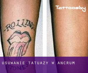 Usuwanie tatuaży w Ancrum