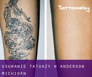 Usuwanie tatuaży w Anderson (Michigan)