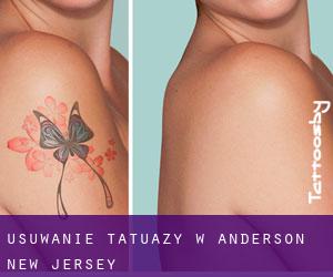Usuwanie tatuaży w Anderson (New Jersey)
