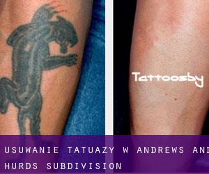 Usuwanie tatuaży w Andrews and Hurds Subdivision
