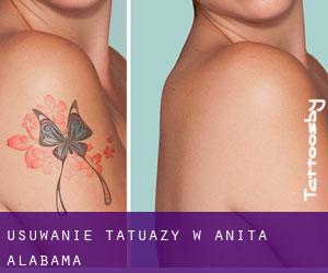 Usuwanie tatuaży w Anita (Alabama)