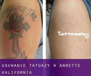 Usuwanie tatuaży w Annette (Kalifornia)