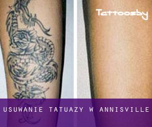 Usuwanie tatuaży w Annisville
