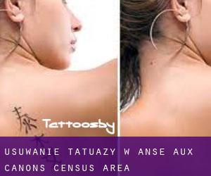 Usuwanie tatuaży w Anse-aux-Canons (census area)