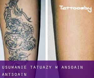 Usuwanie tatuaży w Ansoáin / Antsoain