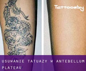 Usuwanie tatuaży w Antebellum Plateau