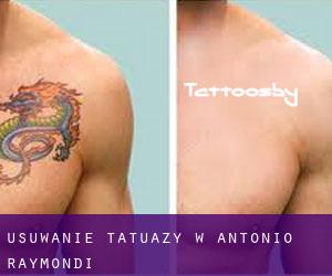 Usuwanie tatuaży w Antonio Raymondi
