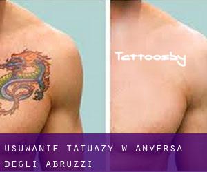 Usuwanie tatuaży w Anversa degli Abruzzi