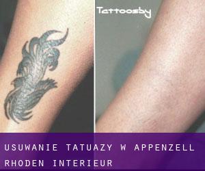 Usuwanie tatuaży w Appenzell Rhoden-Intérieur