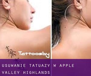 Usuwanie tatuaży w Apple Valley Highlands