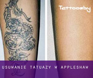 Usuwanie tatuaży w Appleshaw
