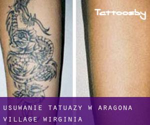 Usuwanie tatuaży w Aragona Village (Wirginia)