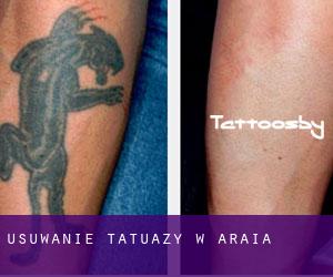 Usuwanie tatuaży w Araia