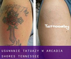 Usuwanie tatuaży w Arcadia Shores (Tennessee)