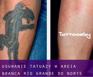 Usuwanie tatuaży w Areia Branca (Rio Grande do Norte)