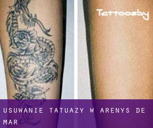 Usuwanie tatuaży w Arenys de Mar