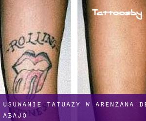 Usuwanie tatuaży w Arenzana de Abajo